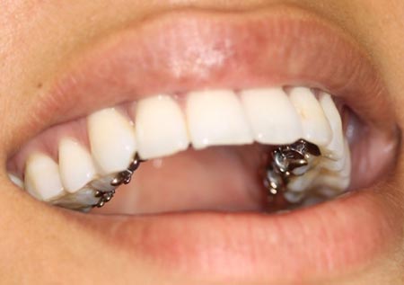 Teeth2