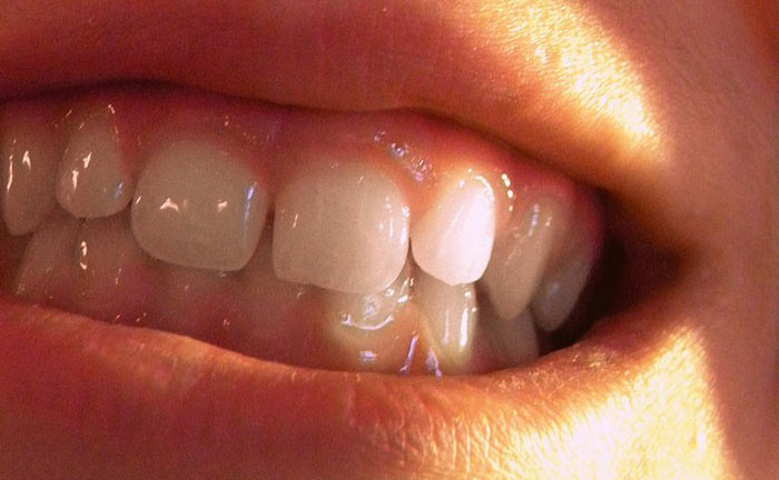 overbite12