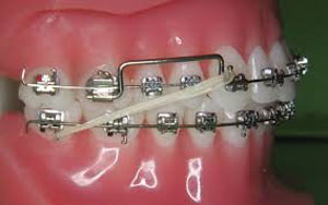 overbite5