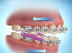 overbite6