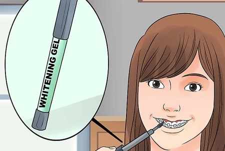 از ژل سفیدکننده دندان استفاده کنید