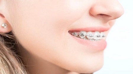 رژیم غذایی مناسب در ارتودنسی
