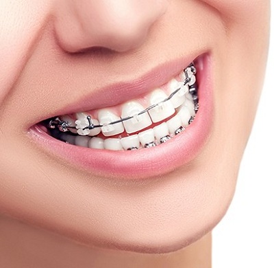 سوالات رایج مرتبط با ارتودنسی