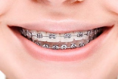 هزینه استفاده از بریس ها